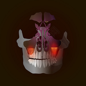 筛骨从真实图像到带有疼痛和炎症点的线性 X 射线效果的过渡 牙源性鼻窦炎 由于牙根疾病引起的上颌窦炎症 伴有疼痛和炎症插画