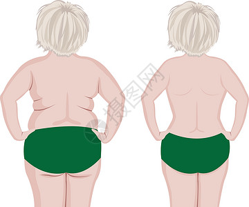 抽脂手术肥胖瘦瘦瘦的姑娘组织腹部重量健康脂肪外科橘皮营养苗条肚子设计图片