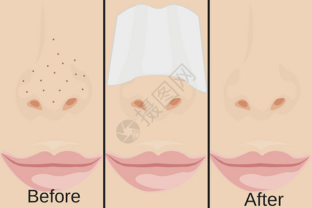 鼻子黑头鼻子上的黑头和治疗方法设计图片