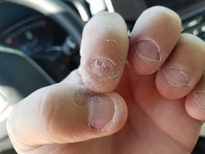 车内令人恶心的咬人和剥皮指甲拇指坏习惯汽车手指图片素材