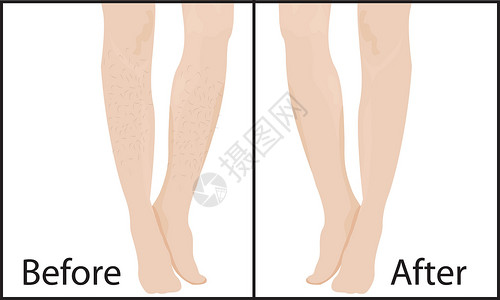 除毛器脱毛方法和结果矢量图前后设计图片