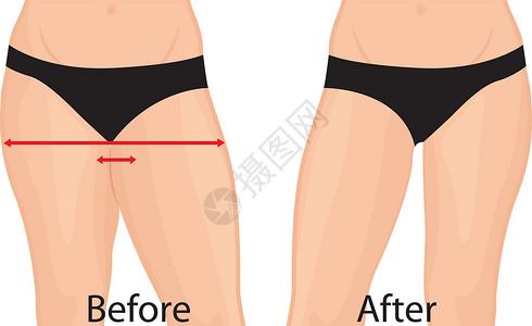 肥大腿矫正 抽脂术 之前和之后 它制作图案的女人身体矫正矢量手术训练组织锻炼减肥运动重量肥胖外科女孩背景图片