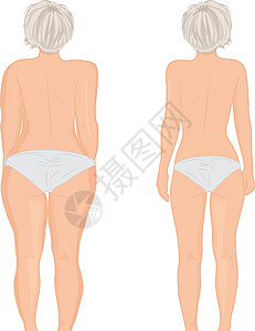 胖瘦的女孩回来了 胖子 抽脂术 之前和之后 它制作图案的女人身体矫正矢量背景图片