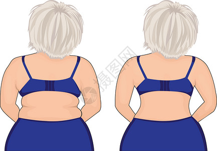 腹部训练胖瘦的女孩回来了 胖子 抽脂术 之前和之后插画