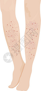 外阴瘙痒女性腿上的丝虫病设计图片