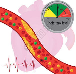 降低血脂血管中的动脉粥样硬化斑块好和坏脂质插画