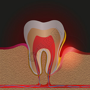 伴有疼痛和炎症的牙科疾病 牙根炎症牙龈疾病脓液在牙龈口袋斑块和牙结石中的医学说明 牙周炎牙周炎牙龈炎背景图片