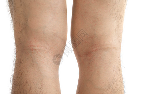 关紧人手的腿皮 保健护理和医疗人员过敏皮疹紊乱高清图片素材