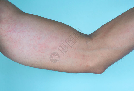 手臂皮肤 保健护理和医疗下部的关紧性过敏皮疹干燥高清图片素材