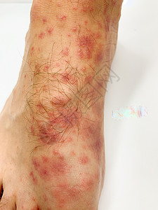 丘疹雄性的脚跟和脚趾贴近了 发红疹发炎疼痛皮炎昆虫身体疾病皮肤科麻疹侵蚀细菌表皮背景