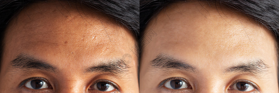 两张图片对比治疗前后的效果 治疗前后有雀斑 毛孔 暗沉 额头皱纹等问题的皮肤 解决皮肤问题 让皮肤变好背景