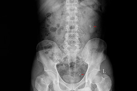 骨骼钙一名肾和尿质石患者X光片背景