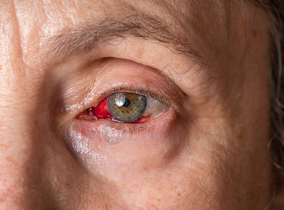 眼睛有血素材高龄女性眼神紧贴与结膜炎或粉红眼睛 在虹膜周围背景