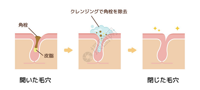 洁面啫喱毛孔结构示意图 清除角质栓塞白头 清洁后的黑头气泡皮肤科打扫组织皮肤载体擦洗粉刺化妆品表皮插画