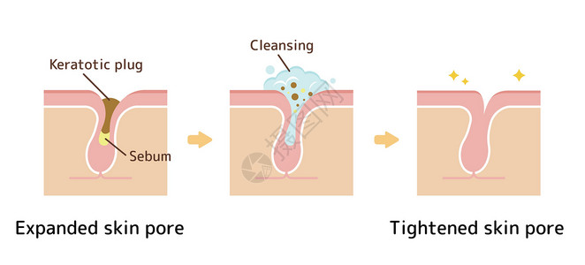 洁面啫喱毛孔结构示意图 清除角质栓塞白头 清洁后的黑头擦洗插图头发皮肤科皮肤粉刺细胞治疗图表化妆品插画