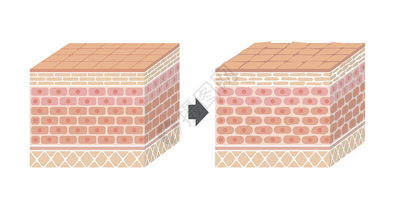 皮肤角质层皮肤剖面图 健康皮肤与受伤滑雪者保护效果对比图商业障碍损害真皮学校细菌图表药品解剖学信息设计图片