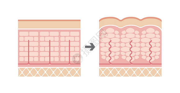 皮肤图正常皮肤和橘皮组织滑雪的比较图饮食脂肪绘画身体表皮胶原插图保健图表卫生设计图片
