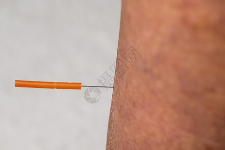 腿上助产针刺治疗疗法自然中医艾灸皮肤医疗药品治愈者加热康复健康高清图片素材
