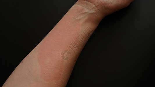 女性手被红色斑点覆盖 贴近伤口 过敏反应皮炎皮疹疼痛表皮病人过敏压力手指疾病皮肤药品高清图片素材
