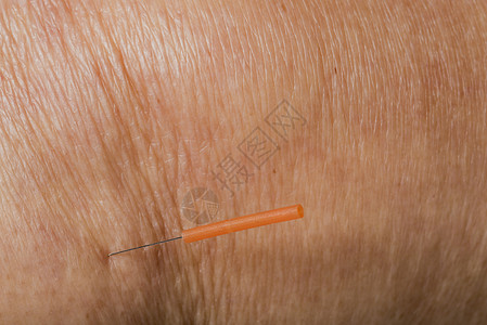 腿上助产针刺治疗艾灸中医药品皮肤治愈者自然康复加热疗法医疗卫生保健高清图片素材