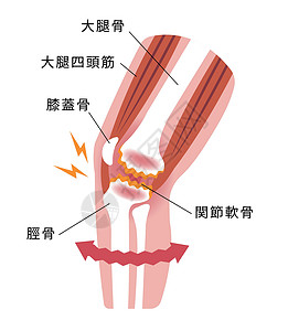 骨骼疼痛膝关节疼痛膝关节病骨关节炎膝关节病 平面插画卫生生物骨骼生物学女性替代品膝盖身体解剖学病人插画