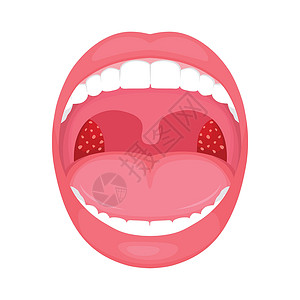 喉咙细菌和病毒感染扁桃体发炎链球菌咽炎感染医疗心绞痛插图解剖学组织药品腺体背景图片