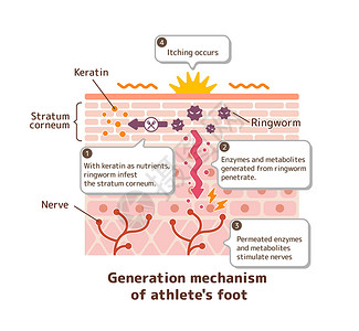 皮肤真菌脚癣病媒制作图案的产生机制感染肿胀手指疾病皮肤痛苦治疗皮炎保健角质层设计图片
