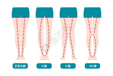 直腿抬高不同类型的腿部角度和膝盖矢量图解 正常保龄球腿外翻手术膝关节炎保健股骨骨科治疗外科疾病女士女性插画