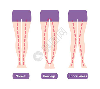 直腿抬高不同类型的腿部角度和膝盖矢量图解 正常保龄球腿外翻疾病平衡治疗手术骨科膝关节炎外科身体女性股骨插画