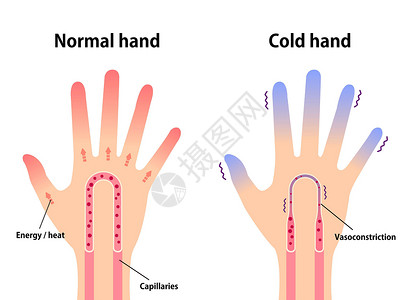 手指图正常手和冷手对指尖冷的敏感度比较图卡通片手指血液循环蓝色女性状况疼痛疾病流感成人设计图片
