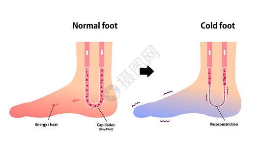 上脚图正常足和冷足对冷脚趾敏感度的比较图症状插图卡通片女士身体疼痛寒潮流感女性器官插画