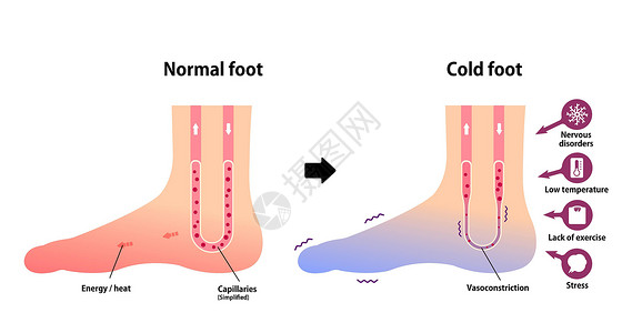 上脚图正常足和冷足对冷脚趾敏感度的比较图疾病器官身体症状状况寒冷插图流感疼痛女性插画