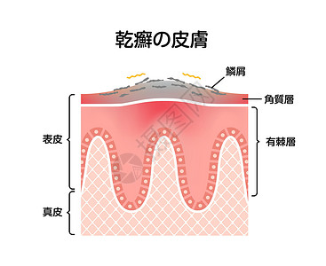 皮肤发痒牛皮癣皮肤扁平载体它制作图案的横截面药品疼痛皮肤科症状感染科学牌匾细胞疾病身体插画