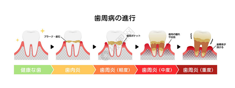 牙周病牙周炎病媒它制作图案的阶段解剖学牙科牌匾口臭疾病护理细菌本质清洁度横截面插画