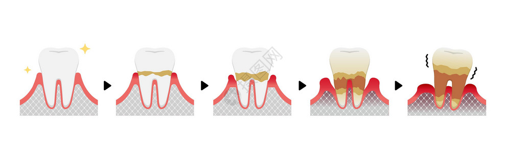 牙周病牙周炎病媒它制作图案的阶段插图疾病护理清洁度医疗口臭细菌牙齿横截面口服插画