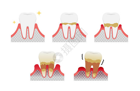 牙周病牙周炎病媒它制作图案的阶段牙齿治疗搪瓷插图牙周口臭口服牙医感染保健插画