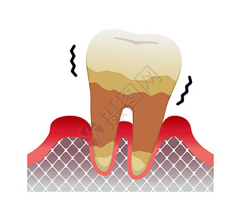 牙周病牙周炎疾病的阶段严重牙周炎插画
