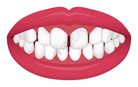 牙列拥挤牙齿问题咬合型歪牙矢量图解过度 Spacin插画