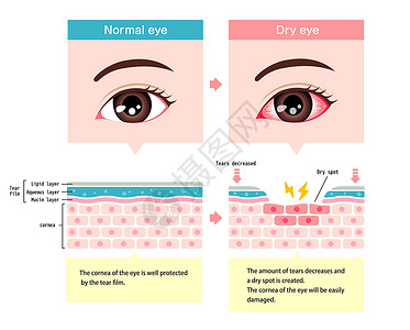 正常眼和干眼的比较图 眼表横截面青光眼疼痛治疗药品眼泪鸢尾花过敏疾病瞳孔工人插画