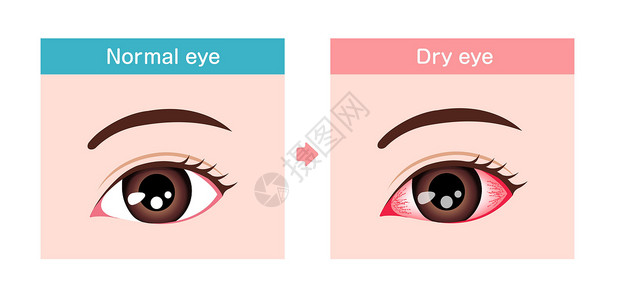 正常眼和干眼的对比图插画