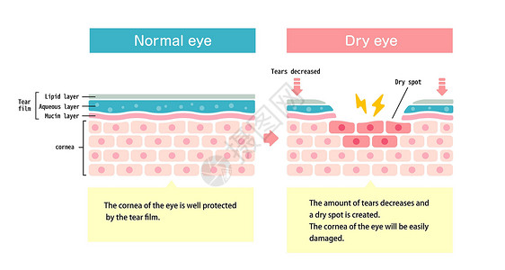 正常眼和干眼的比较图 眼表横截面疾病镜片过敏案头工作瞳孔眼泪工人插图解剖学插画