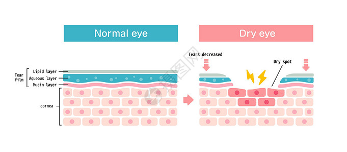 正常眼和干眼的比较图 眼表横截面工人工作眼科办公室眼睛治疗药品案头青光眼过敏插画