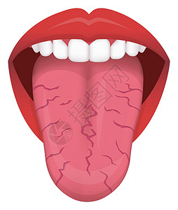 舌头健康标志矢量图裂纹舌高清图片