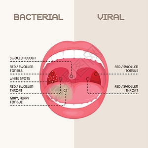 喉咙细菌和病毒感染扁桃体发炎组织链球菌心绞痛咽炎腺体症状插图药品疾病感染背景图片
