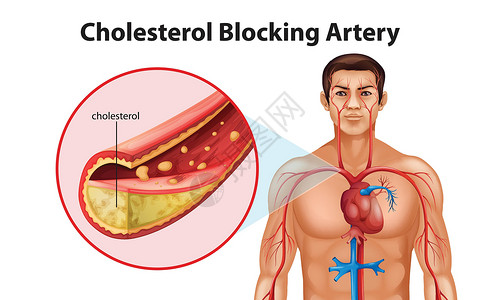 高血动脉硬化疾病致命艺术插图牌匾导管支架动脉粥样硬化攻击心脏病插画