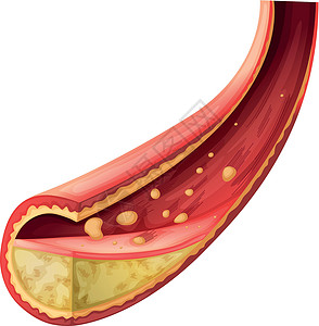 血管支架动脉被胆固醇阻塞插画