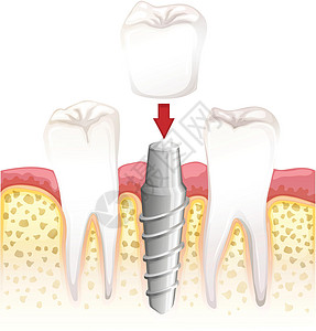 牙冠手术铸件草图程序牙齿科学口服医疗图表金属意义设计图片