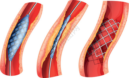 血管支架用于打开阻塞动脉的支架插画