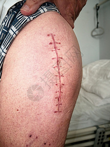 臀部关节手术后留下的疤痕 替换断裂的臀部关节 以取代臀部内分泌背景图片