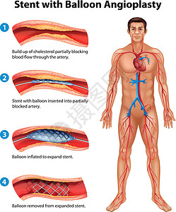 血管支架支架血管成形术药品心脏病外科手术导管硬化牌匾插图医生动脉插画